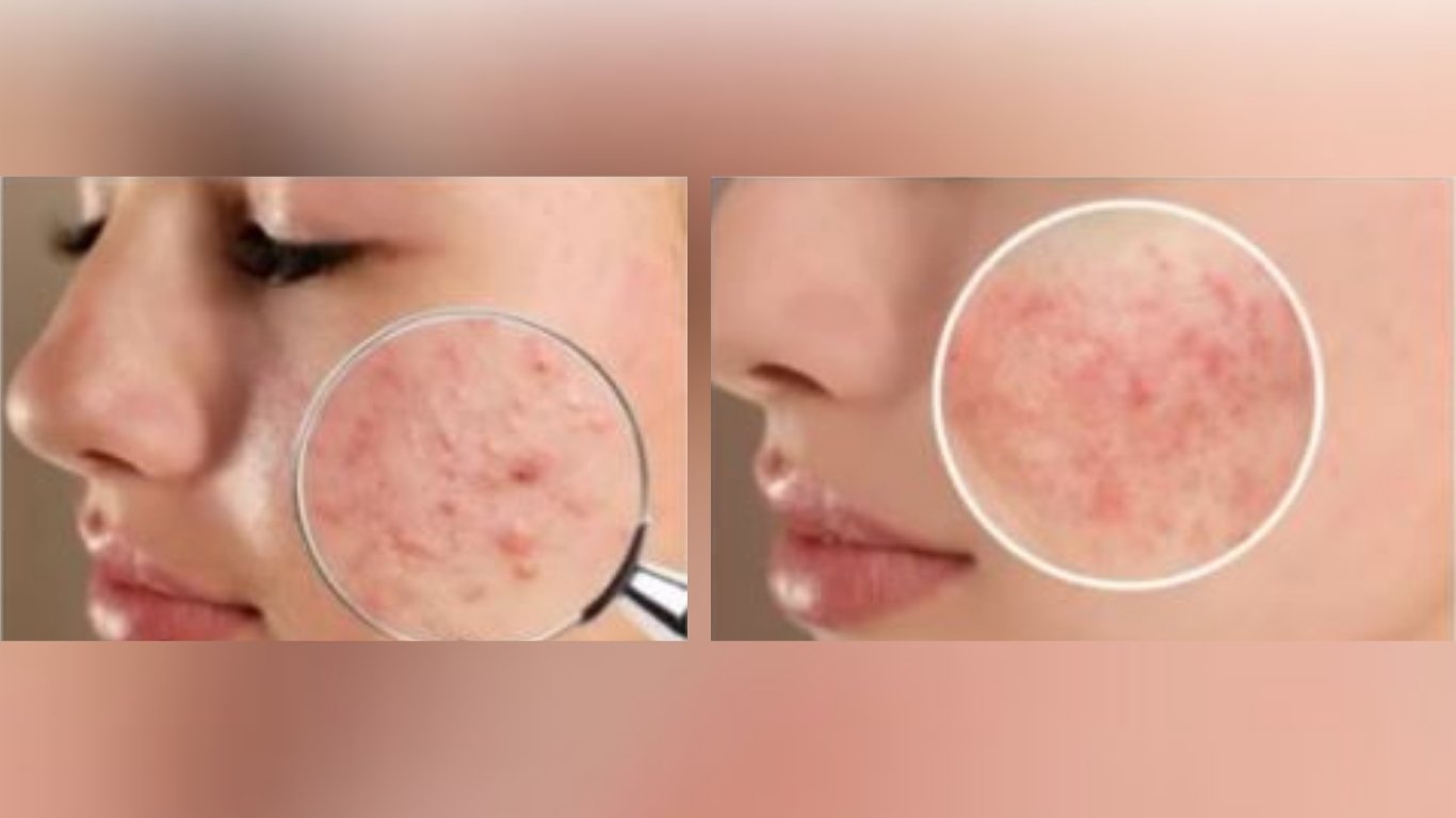 Rosacea redness can be tough to calm, but not impossible to treat.