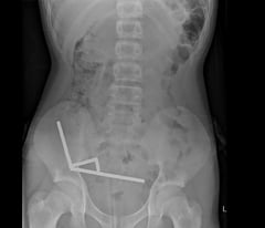 Surgeons remove 100 magnets from teen’s gut