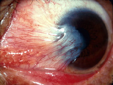 PhilHealth upgrades pterygium treatment standards