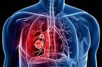 Lung cancer toll rises as detection lags