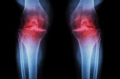 Anti-aging injection shows promise against arthritis pain