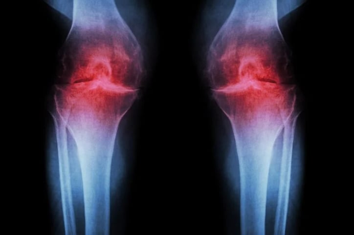 Anti-aging injection shows promise against arthritis pain