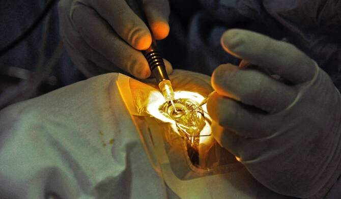 WHO: 94M need cataract surgery