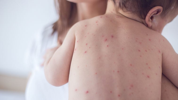 Infants at risk as measles cases climb