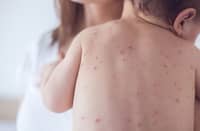 Infants at risk as measles cases climb