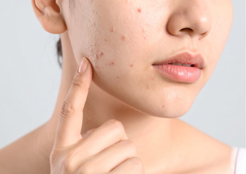 Hot weather, bad skin? Here’s how you can fight back