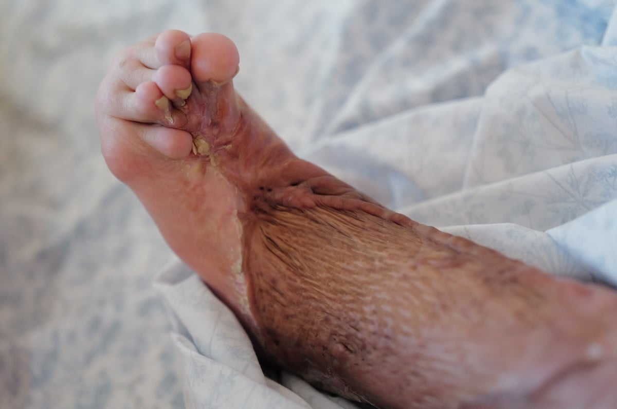 ‘The SCAR Project’ provides customized treatment and rehabilitation for individuals living with life-altering scars.