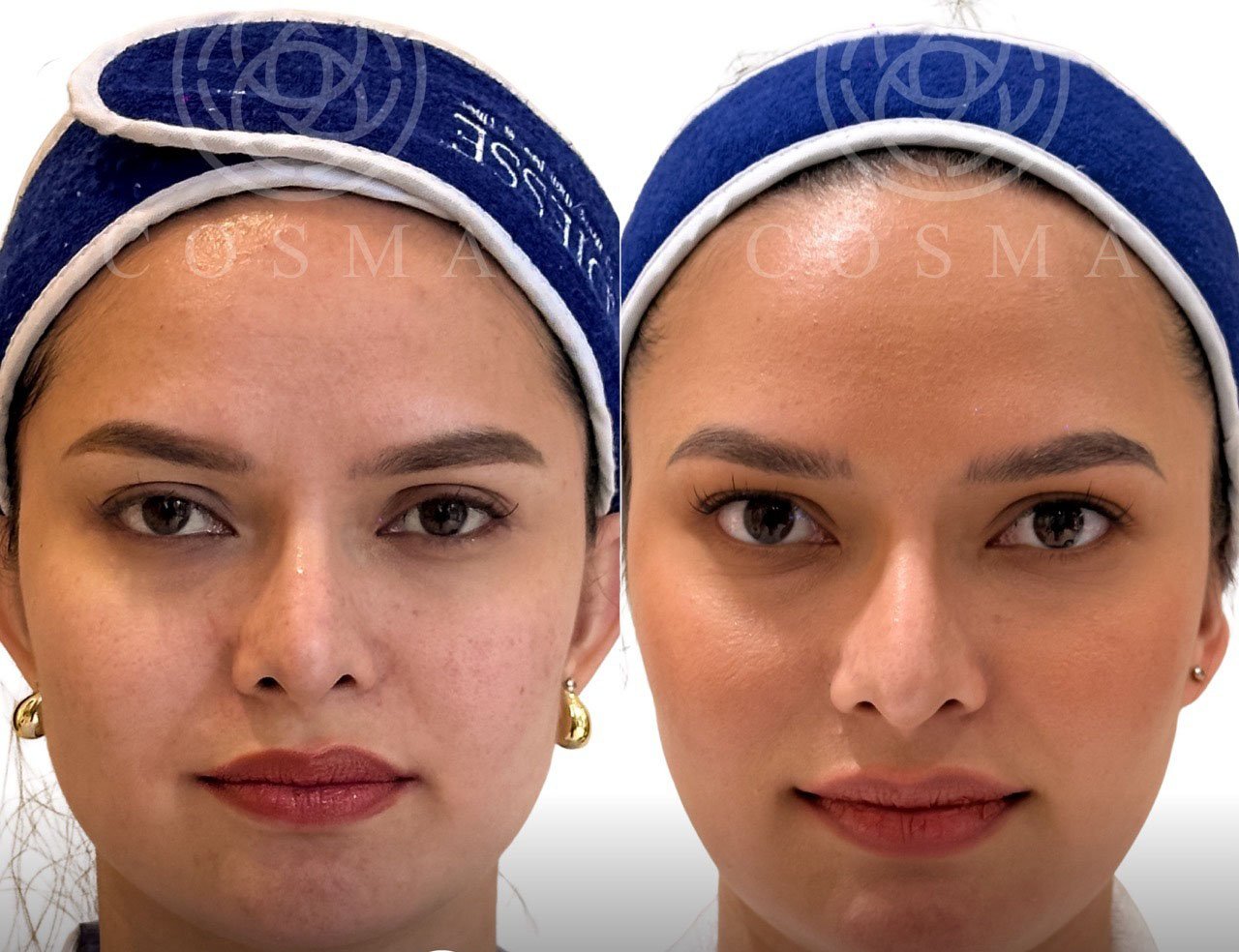 Filipinos rebelling against extreme TikTok beauty trends — doctor 