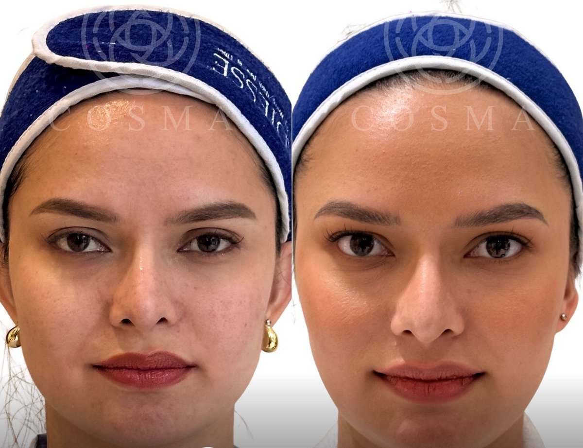 Filipinos rebelling against extreme TikTok beauty trends — doctor