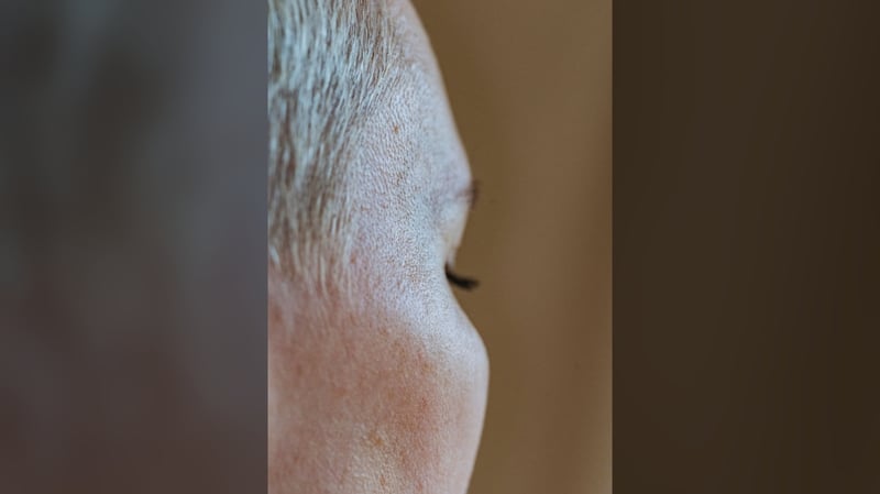 Ways to slow hairline recession