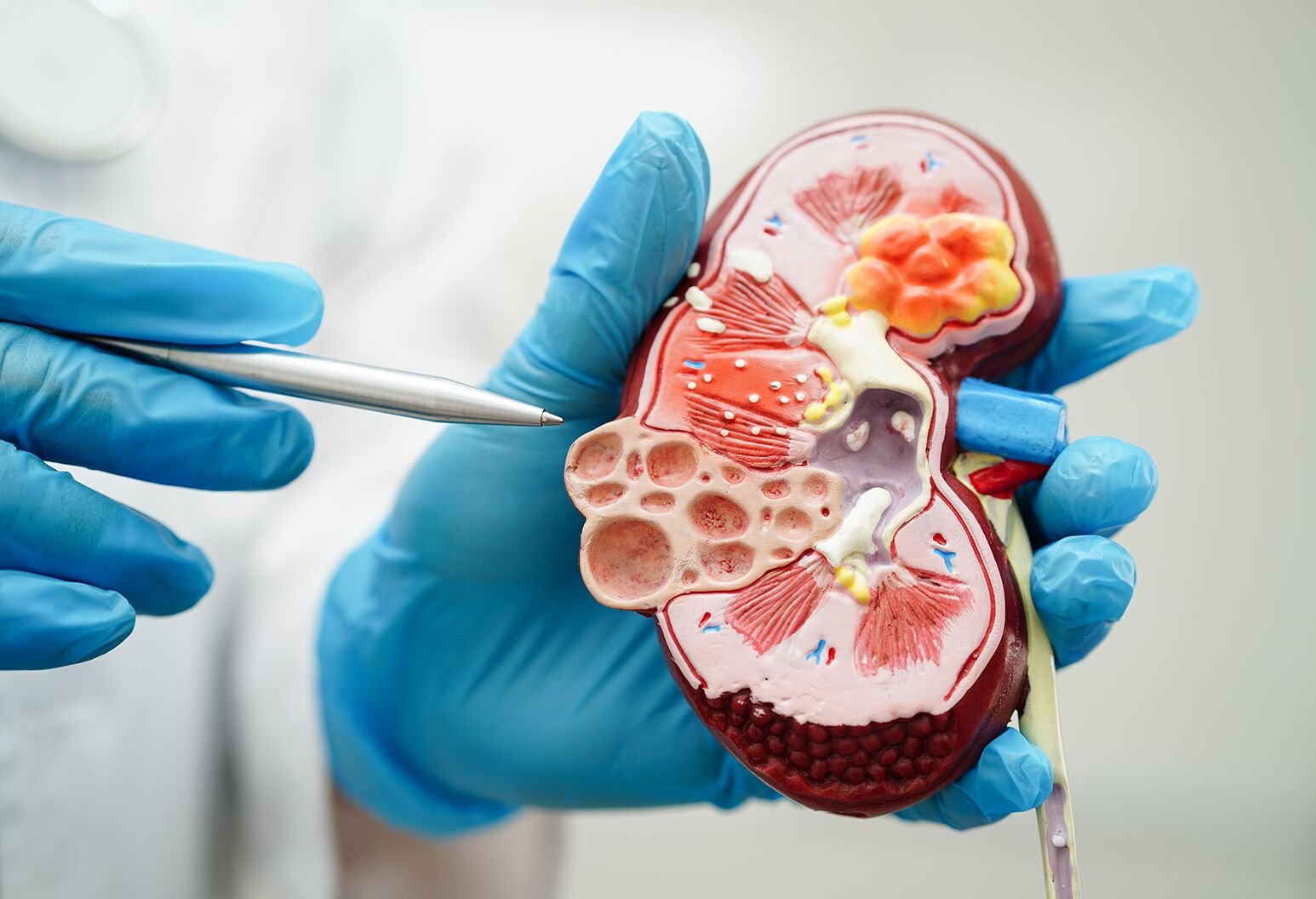 REGULAR kidney screening and healthy lifestyle choices are key to preventing chronic kidney disease, health advocates said