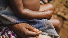 Guinea-Bissau faces mpox outbreak