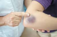 FREQUENT bruising may warrant medical evaluation.