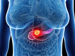 Pancreatic cancer drug approved