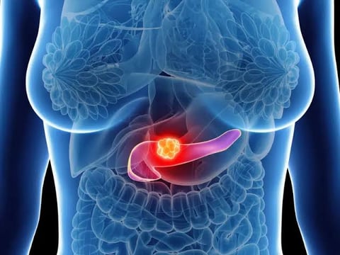 Pancreatic cancer drug approved