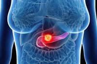 Pancreatic cancer drug approved